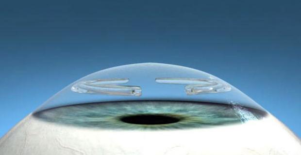 Corneal Rings – Keratoconus Treatment Risks, Candidacy & Costs