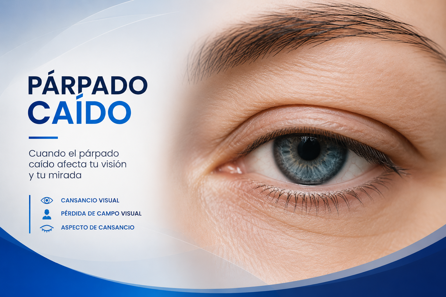 Parpados Caidos