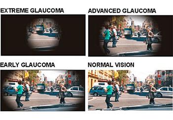 Glaucoma