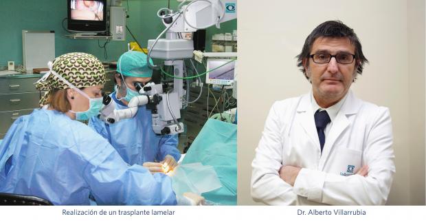 trasplante lamelar; Dr. Alberto Villarrubia; Innova Ocular La Arruzafa